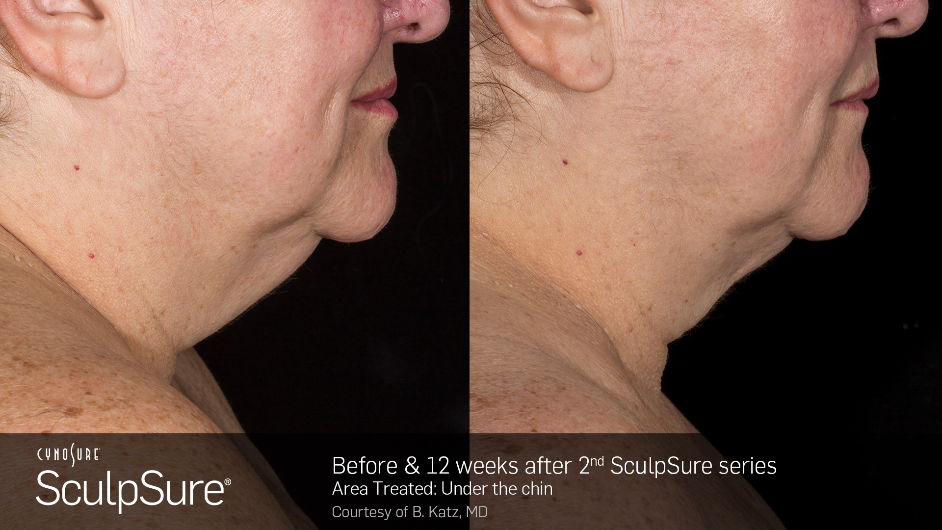 Before and after Sculpsure 2